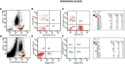 A case report of early diagnosis of asymptomatic hairy cell leukemia using flow cytometry